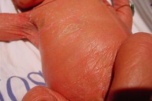 Врожденная ихтиозиформная эритродермия Брока: причини виникнення та основні симптоми, способи лікування захворювання