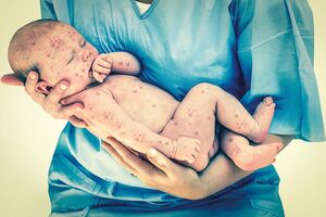 Врожденная краснуха: причини виникнення та основні симптоми, способи лікування захворювання