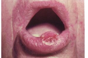 Бородавчатый предрак красной каймы губ: причини виникнення та основні симптоми, способи лікування захворювання