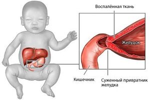 Врожденный пилоростеноз: причины возникновения и основные симптомы, способы лечения заболевания