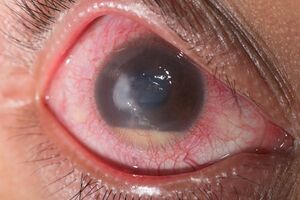Вторичная глаукома: причини виникнення та основні симптоми, способи лікування захворювання