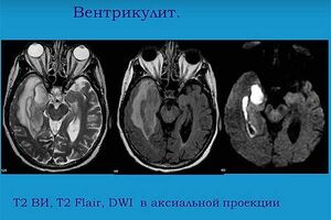 Вентрикулит: причины возникновения и основные симптомы, способы лечения заболевания