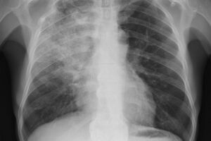 Вентилятор-ассоциированная пневмония: причины возникновения и основные симптомы, способы лечения заболевания