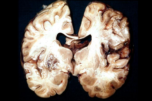 Аспергиллез головного мозга: причины возникновения и основные симптомы, способы лечения заболевания
