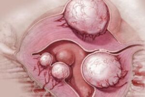 Текалютеиновая киста яичника: причины возникновения и основные симптомы, способы лечения заболевания