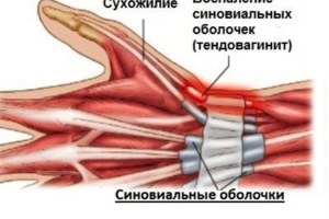 Тендовагинит кисти: причины возникновения и основные симптомы, способы лечения заболевания
