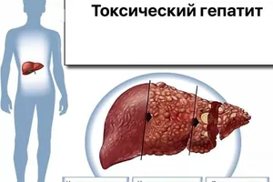 Токсический гепатит: причины возникновения и основные симптомы, способы лечения заболевания