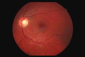 Токсическое поражение зрительного нерва: причины возникновения и основные симптомы, способы лечения заболевания