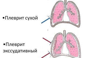 Сухой плеврит: причини виникнення та основні симптоми, способи лікування захворювання