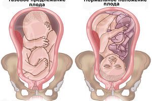 Тазовое предлежание плода: причины возникновения и основные симптомы, способы лечения заболевания