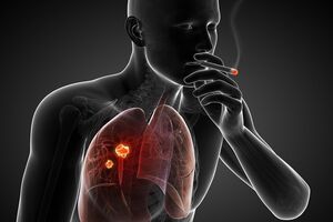Рак легких: причины возникновения и основные симптомы, способы лечения заболевания
