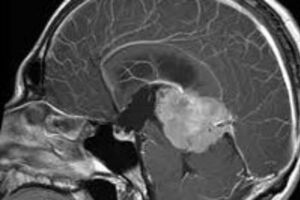 Герминома головного мозга: причини виникнення та основні симптоми, способи лікування захворювання
