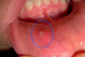 Декубитальная язва полости рта: причины возникновения и основные симптомы, способы лечения заболевания