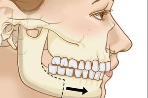 Дефекты нижней челюсти: причины возникновения и основные симптомы, способы лечения заболевания