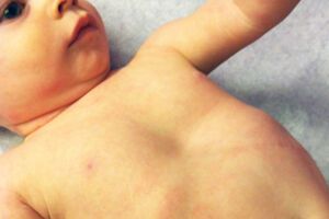 Деформации грудной клетки у детей: причини виникнення та основні симптоми, способи лікування захворювання