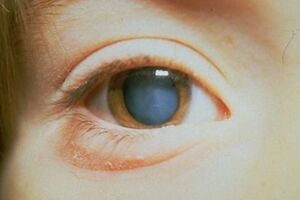 Диабетическая катаракта: причины возникновения и основные симптомы, способы лечения заболевания