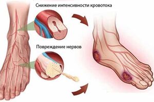 Диабетическая макроангиопатия: причини виникнення та основні симптоми, способи лікування захворювання
