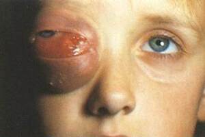 Глиома зрительного нерва: причины возникновения и основные симптомы, способы лечения заболевания