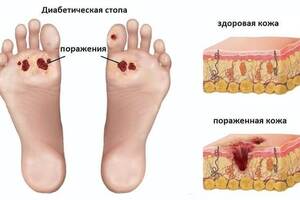 Диабетическая стопа: причини виникнення та основні симптоми, способи лікування захворювання