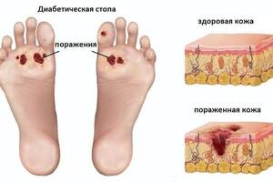 Диабетическая стопа: причины возникновения и основные симптомы, способы лечения заболевания