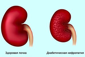 Диабетическая нефропатия: причины возникновения и основные симптомы, способы лечения заболевания
