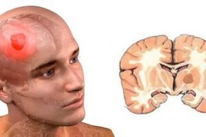 Глиома головного мозга: причини виникнення та основні симптоми, способи лікування захворювання