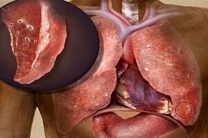 Гнойный бронхит: причины возникновения и основные симптомы, способы лечения заболевания