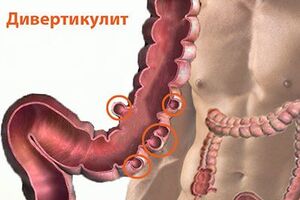 Дивертикулит: причины возникновения и основные симптомы, способы лечения заболевания