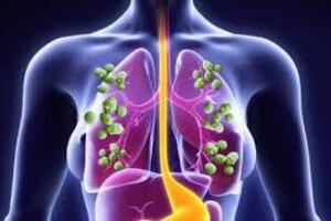 Грибковая пневмония: причини виникнення та основні симптоми, способи лікування захворювання