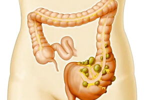 Дивертикулярная болезнь толстого кишечника: причини виникнення та основні симптоми, способи лікування захворювання