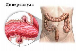 Дивертикулы кишечника: причины возникновения и основные симптомы, способы лечения заболевания