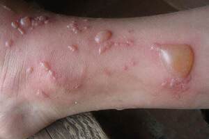 Буллезный дерматит: причины возникновения и основные симптомы, способы лечения заболевания