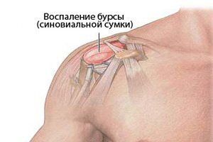 Бурсит плечевого сустава: причини виникнення та основні симптоми, способи лікування захворювання