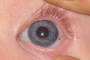 Гемангиома глаза: причины возникновения и основные симптомы, способы лечения заболевания