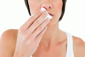 Гематома носовой перегородки: причини виникнення та основні симптоми, способи лікування захворювання