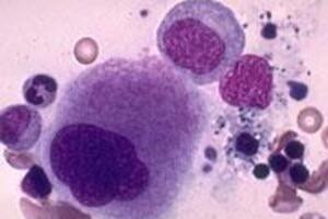 Гемофагоцитарный лимфогистиоцитоз: причины возникновения и основные симптомы, способы лечения заболевания