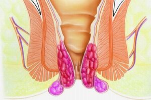 Выпадение геморроидальных узлов: причины возникновения и основные симптомы, способы лечения заболевания