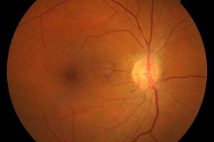 Гипертоническая ретинопатия: причини виникнення та основні симптоми, способи лікування захворювання