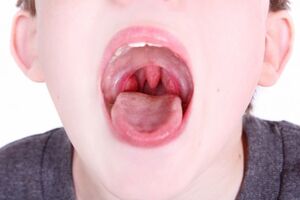 Гипертрофия нёбных миндалин: причини виникнення та основні симптоми, способи лікування захворювання