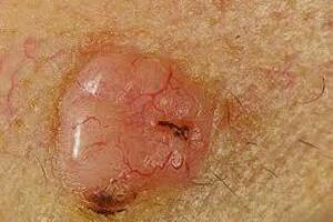 Злокачественные опухоли кожи: причины возникновения и основные симптомы, способы лечения заболевания