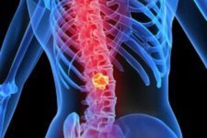 Злокачественные опухоли спинного мозга: причины возникновения и основные симптомы, способы лечения заболевания