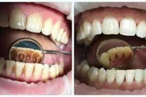 Зубной камень: причины возникновения и основные симптомы, способы лечения заболевания