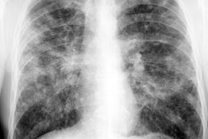 Диссеминированный туберкулез легких: причини виникнення та основні симптоми, способи лікування захворювання