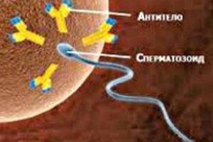 Иммунологическое бесплодие: причины возникновения и основные симптомы, способы лечения заболевания