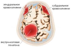 Внутричерепное кровоизлияние: причины возникновения и основные симптомы, способы лечения заболевания