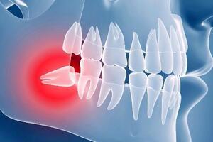 Дистопированный зуб: причини виникнення та основні симптоми, способи лікування захворювання