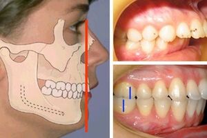 Дистальный прикус: причины возникновения и основные симптомы, способы лечения заболевания