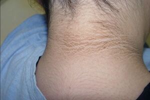 Дистрофия кожи: причины возникновения и основные симптомы, способы лечения заболевания