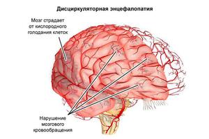 Дисциркуляторная энцефалопатия: причины возникновения и основные симптомы, способы лечения заболевания