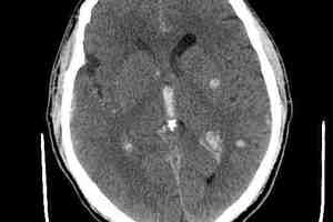 Диффузное аксональное повреждение головного мозга: причини виникнення та основні симптоми, способи лікування захворювання